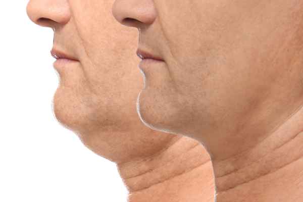 HIFU - Breakthrough in Anti - ageing 2 hifu results Smethwick