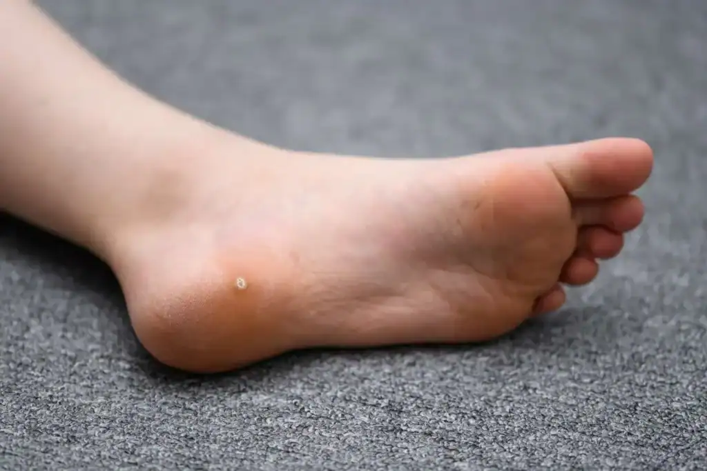 Cryotherapy For Warts And Also Verrucas 2 Image of verruca on the bottom of the foot that able to be treated with Cryotherapy Smethwick