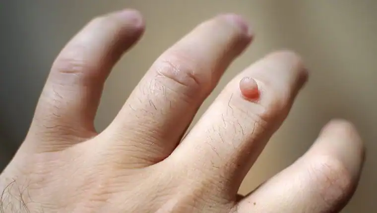 Image of blemish that Cryotherapy Smethwick can remove with Lipo 360.