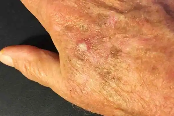 Image of Actinic keratoses Smethwick on a person hand