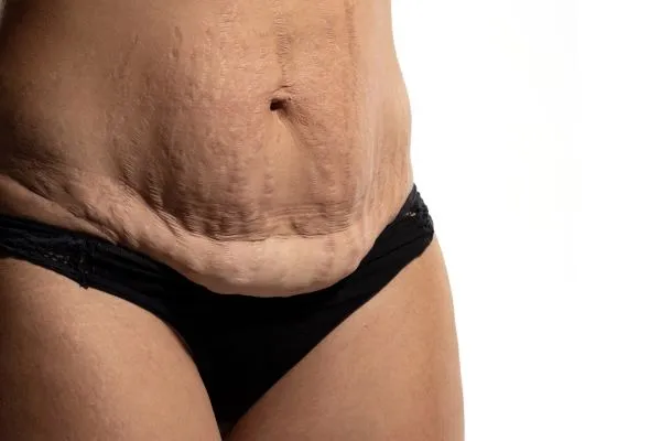The Science of Skin Tightening 1 The science behind skin tightening Smethwick picture of a woman's sagging skin on the stomach